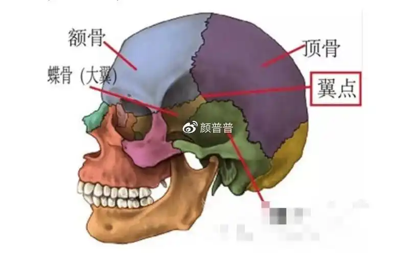 解析面部颧骨颧弓宽?究竟选填充太阳穴还是颧骨内推?