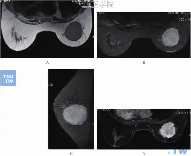 乳腺磁共振检查技术