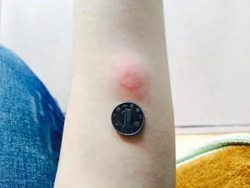 肺结核ppd试验(中间硬结16mm 17mm)无水泡,有双圈,算阳性还是强阳性