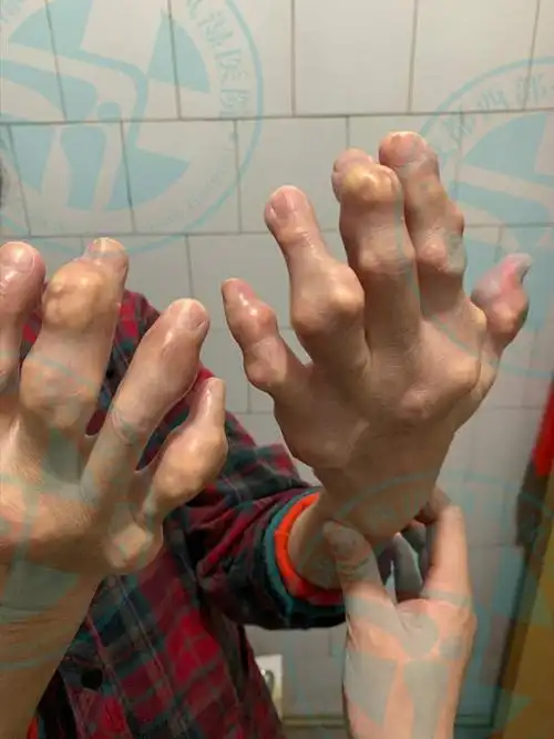 1.痛风:患者体内尿酸水平过高时,尿酸盐结晶可能沉积在关节及