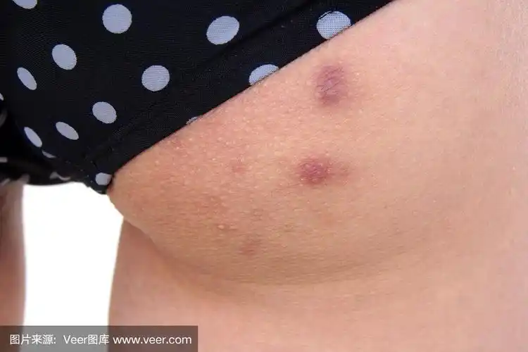 女人屁股上的粉刺