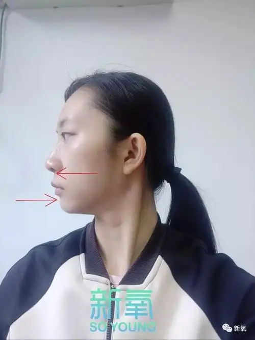 这种程度的 下巴后缩在正面看起来就是,下庭的阴影部分很深,视觉点都