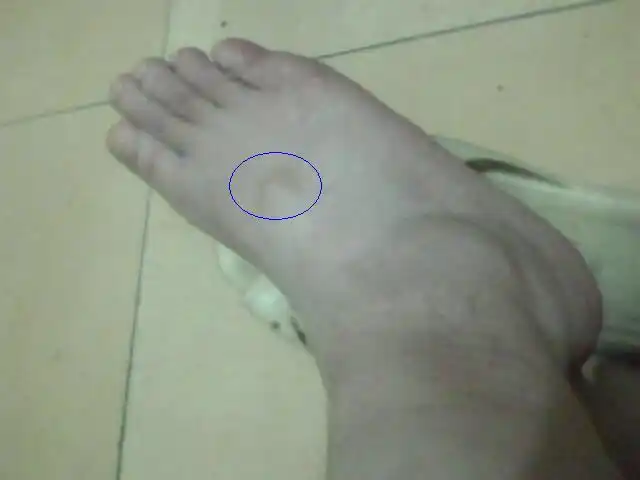 我的右脚背鼓了一个小包,怎么办?