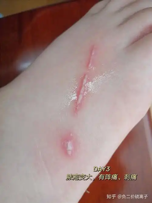 隐翅虫咬后的水泡能不能挤? - 知乎