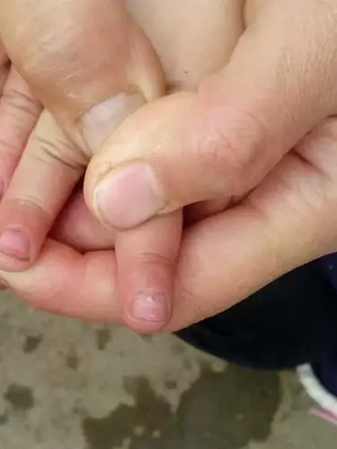 1岁4个月宝宝手指脚指甲根部成灰褐色,像要脱掉一样,请问是怎么回事啊