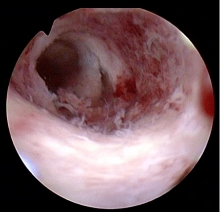 宫腔粘连的症状有哪些(宫腔粘连的症状有哪些危害)