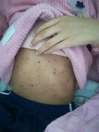 邱县中医院儿科进行水痘病例教学查房