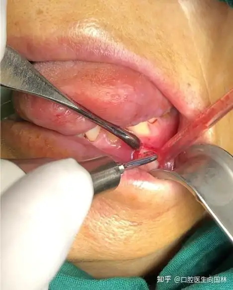 【囊肿手术案例】大型颌骨角化囊肿开窗减压联合囊肿塞治疗