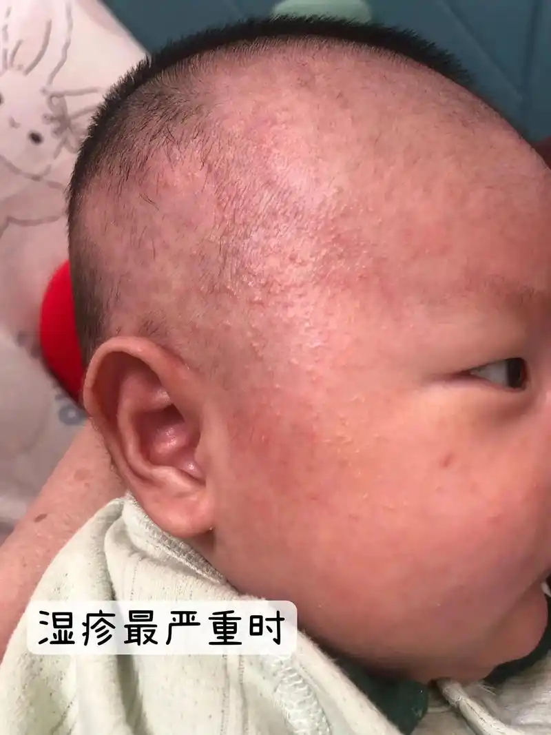 宝宝过了第一道湿疹的坎,是真的让人着急.