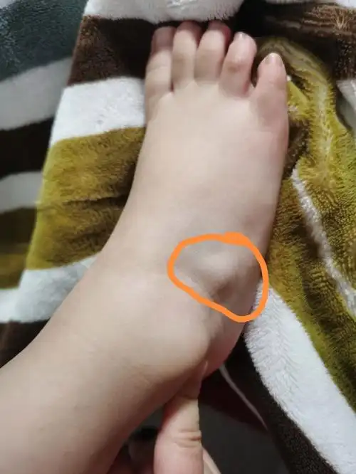 2岁宝宝脚踝处凸出来一个硬包