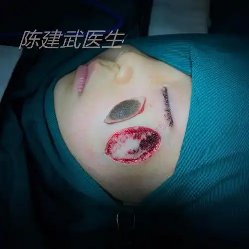 设计切口:据黑痣长径或皮纹方向设计梭形手术切口,为避免两侧皮肤凸起