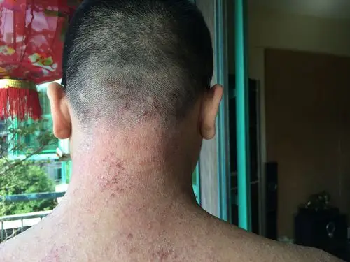 皮肤很痒然后自己挠成这个样子,皮肤还很干,请问这个是什么病?