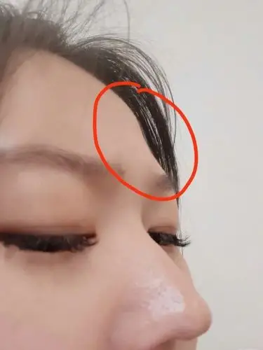 图12就是我没填之前的额头大坑侧面明显