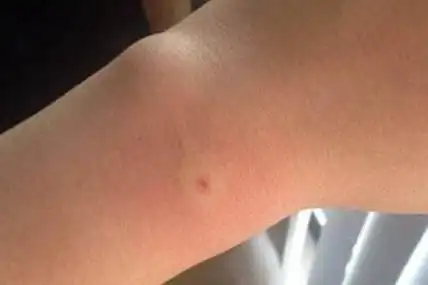 蜜蜂蛰了怎么消肿 , 神奇方法大全(消肿神器:蜜蜂蛰了怎么消肿)-52