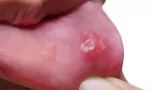 舌头侧边长了两个凹下去的小颗粒还有一层白白的膜很疼是啥