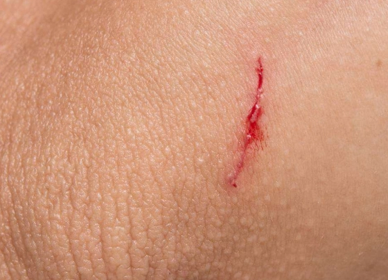 胳膊流血真实图片53