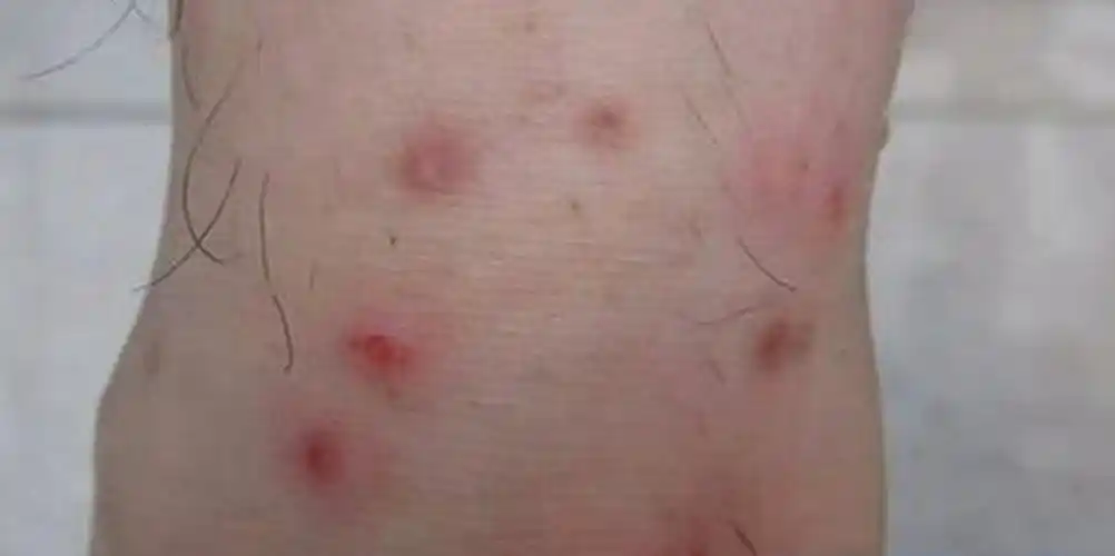 淋病的治疗与图片