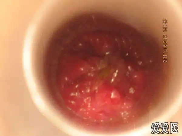 楼主tonyycai2011-10-08 10:12:39患者以一年前在民营医院手术痔疮,术