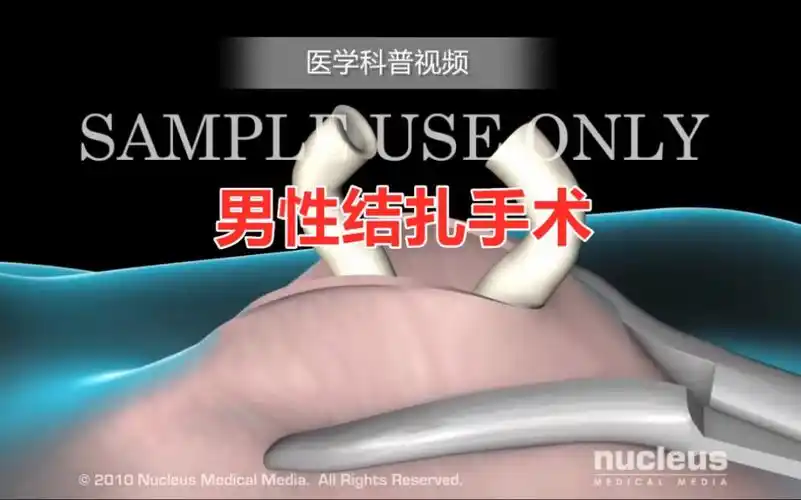 医学科普视频男性结扎手术视频