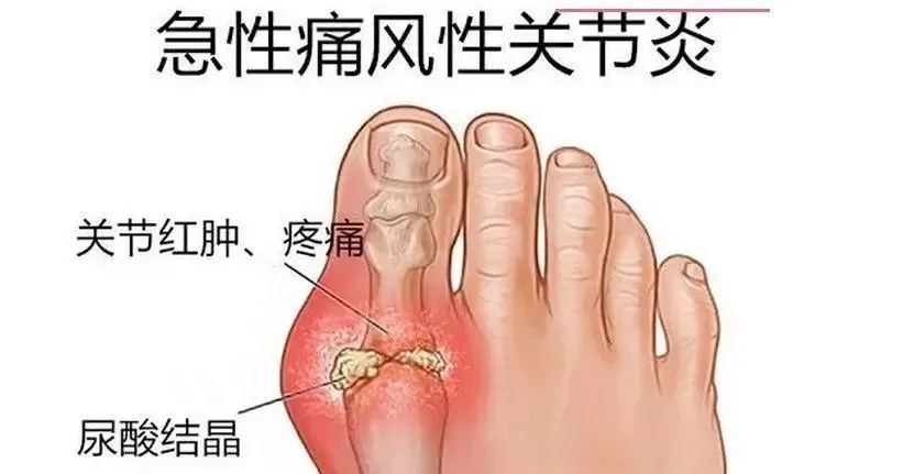 注意!医生喊你"上点心",别让自己一痛就"疯"?