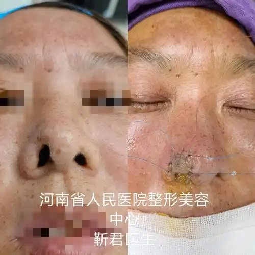 鼻翼缺损的治疗_鼻部整形_鼻部整形治疗介绍 - 好大夫在线