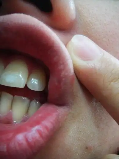 艾滋病早期嘴唇图片 (9)