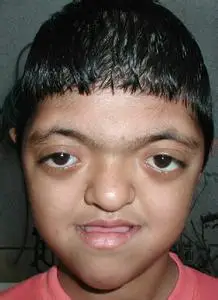 甲亢突眼患者应正确护理眼睛