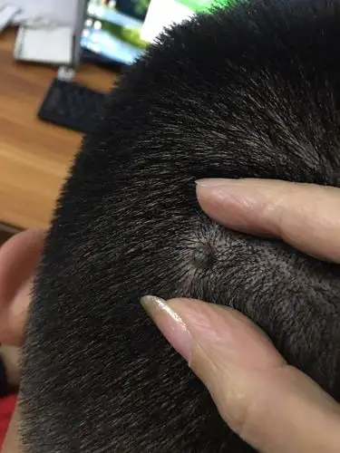 头部后面长了类似痣的黑色东西,没有不适的感觉,不痛不痒,就摸