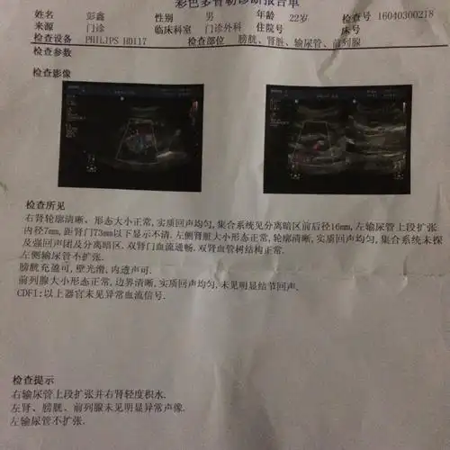我这里b超上写着右肾集合系统见分离暗区前后径16mm,是16mm的肾结石么