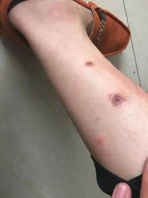 这疙瘩痒的我受不了,破了的那个都两个多月了,这到底是什么啊,去医院