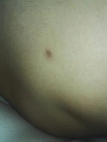 2周前被不知道什么虫子咬了,然后现在被咬的地方变成了这样,有个黑点.