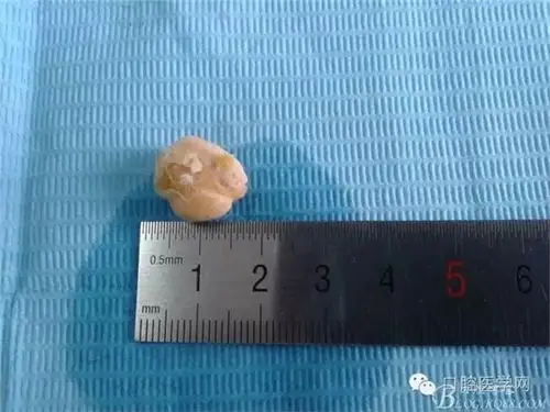 罕见颌下腺结石一例