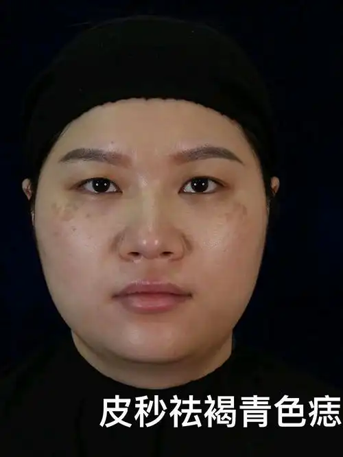 我颧骨上的斑点一直都很明显,我当时是不知道什么斑点_圈子-新氧美容