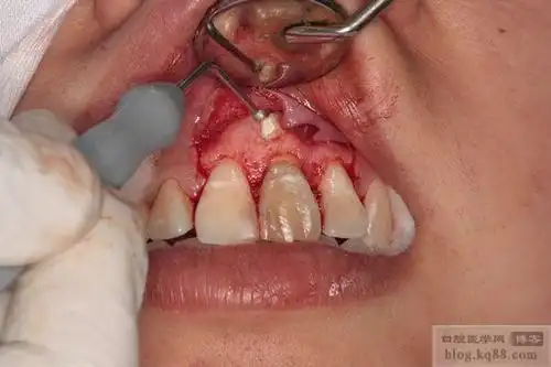 经半年多,在治疗和手术过程中还是存在较多不足,特别是根尖手术这一快