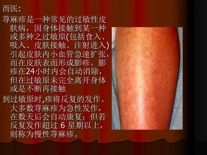 《病案风疹附照片》ppt课件.ppt