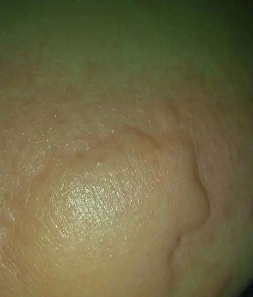 右边屁股一个大包不痛不痒是不是坐久的原因以前没有这种情