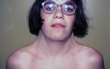 特纳综合征(turner综合征或45,x综合征)