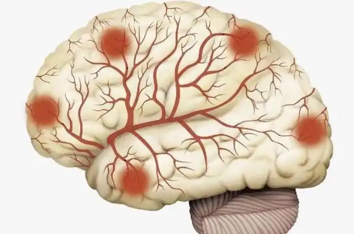 想要离脑血管堵塞远一点这5件事不要做多吃一豆血管通畅
