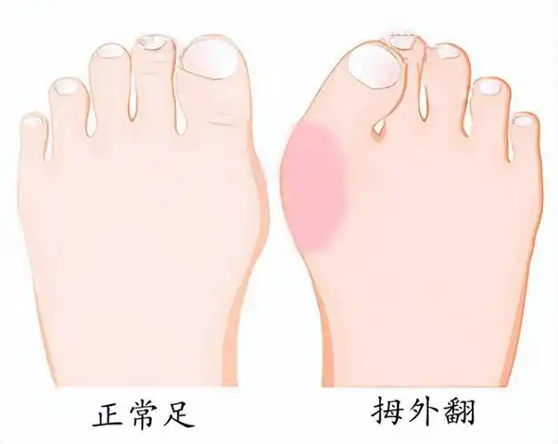 拇外翻是什么引起的?到底该如何矫正?_进行_畸形_手术