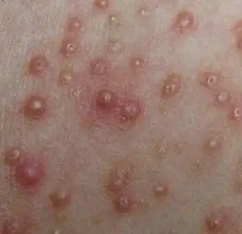 青岛皮肤病研究院指出,女性阴虱原因:阴虱通过与人体接触,虱迅速地