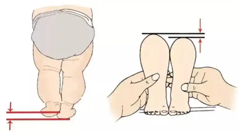 婴儿髋关节不对称图片(宝宝臀纹不对称妈妈不上心) - 赤虎壹号