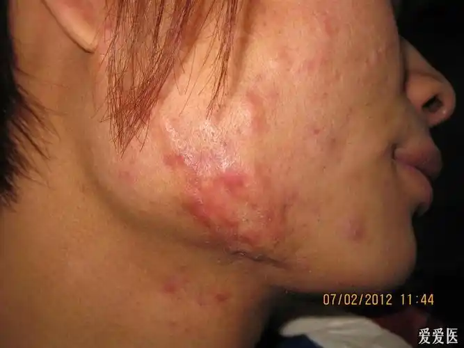 痤疮所致的瘢痕疙瘩