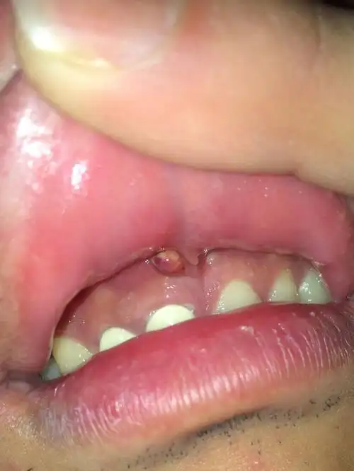 牙龈上长了个东西,有点疼,是什么啊?