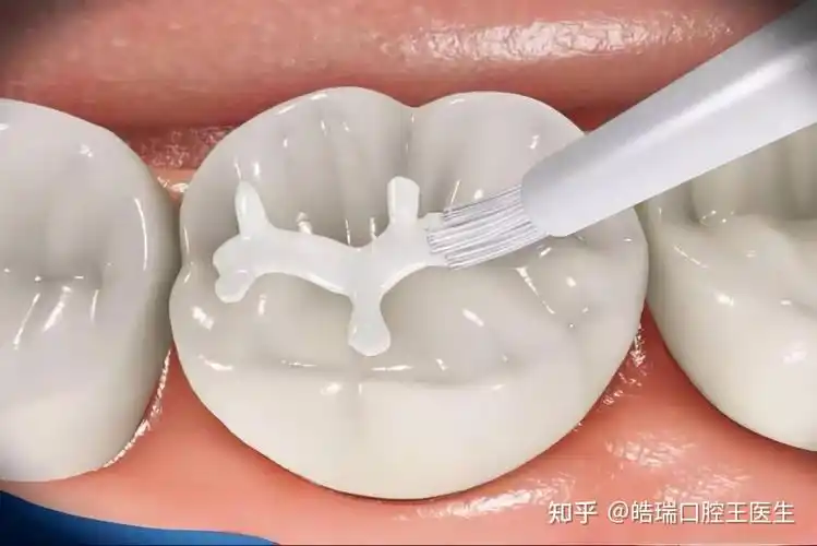 牙齿窝沟封闭就是用一… - 知乎