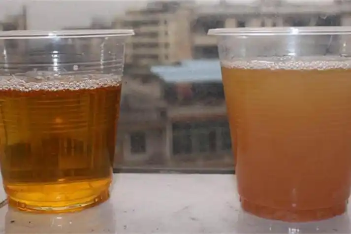 乙肝黄疸尿色加深图