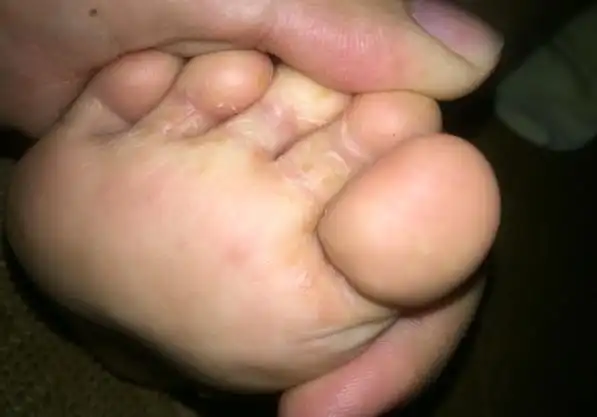 孩子有脚气怎么办?作为家长的一定重视