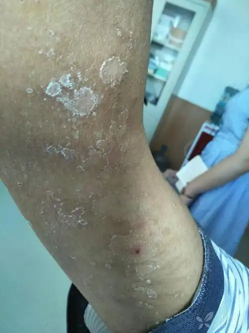 各位老师,门诊遇到一病人,尿毒症透析病人,图片如下,求助 - 皮肤与性