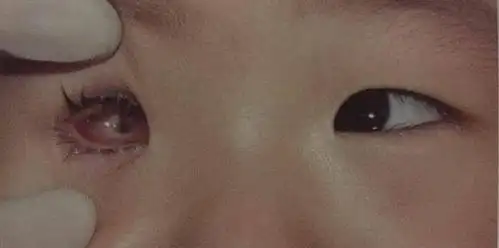 自膨胀水凝胶治疗先天性小眼球,特殊胶水"补"眼睛