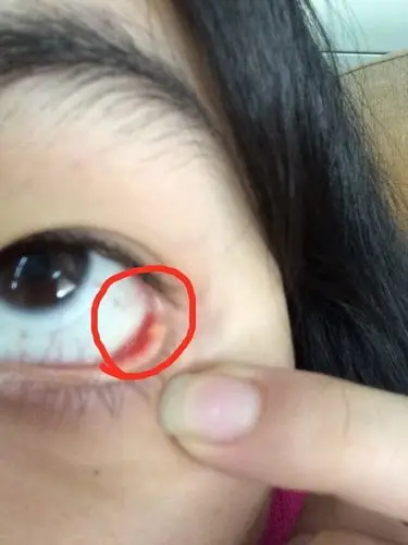 眼角长得小疙瘩,这是怎么回事啊