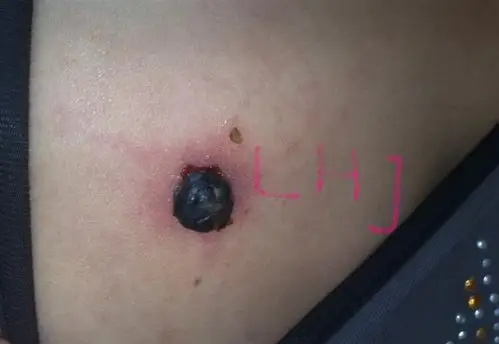 上唇化脓性肉芽肿图片